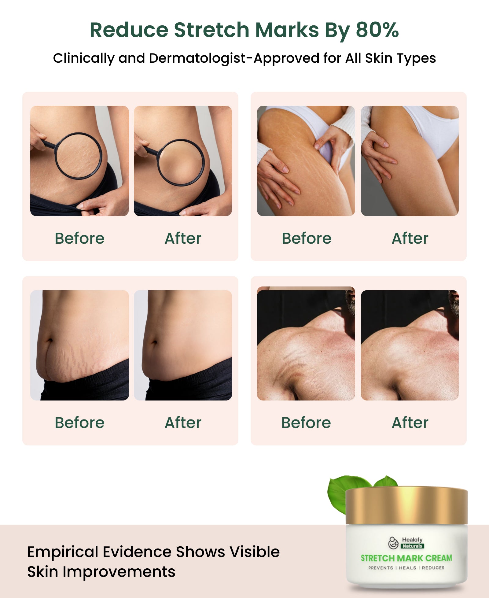 Healofy Naturals Stretchmarks Cream | Fades Stretchmarks in 28 Days with Natural Ingredients